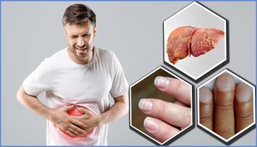  ফ্যাটি লিভার দূর করতে প্রাকৃতিক পথ: জীবনযাত্রায় পরিবর্তনেই মিলতে পারে সমাধান